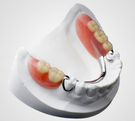 Бюгельный протез. Источник: Дента-АРС