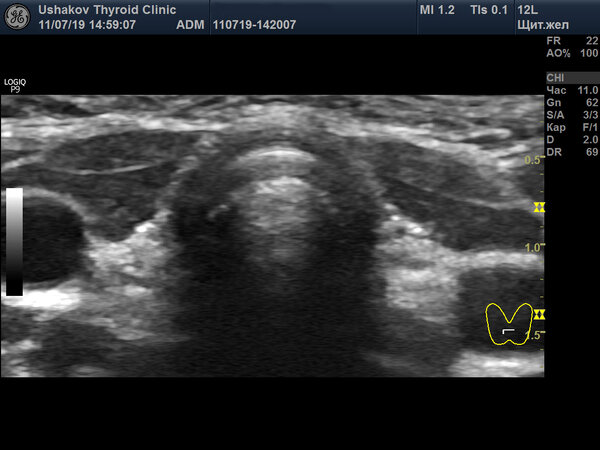 УЗИ щитовидной железы в 5 лет