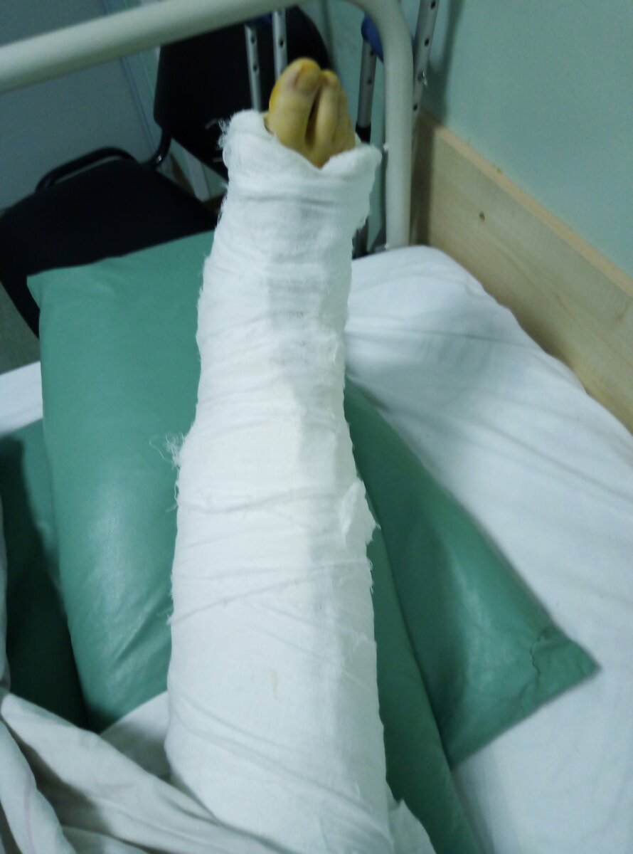 После остеотомии пяточной кости. 