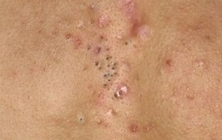 Прыщи, угри и просто черные точки на коже могут появляться не только на лице, но и на всем теле, особенно на спине.-2