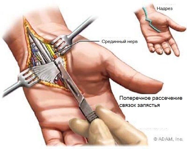 Синдром запястного канала: описание