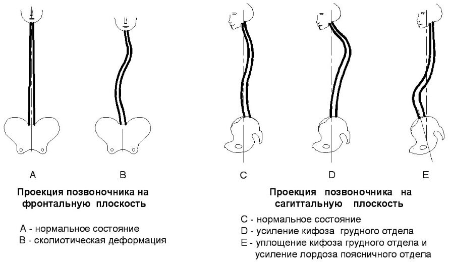 Какой осью является место расположения позвоночного столба Гиперкифоз - что это? Проверь себя! SL Клиника - Spinelife.ru Дзен
