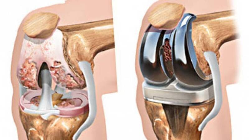 Артроз колена и эндопротезирование сустава