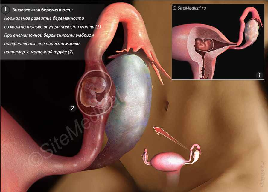 Внематочная беременность картинки для презентации