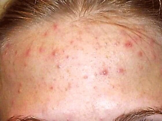 Прыщи взято из интернета