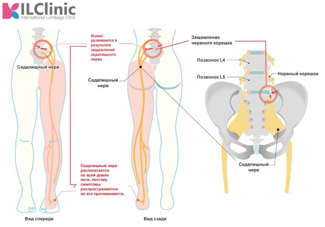 Ишиас: мнение специалистов о лечении болей в пояснице | International  Lumbago Clinic | Дзен