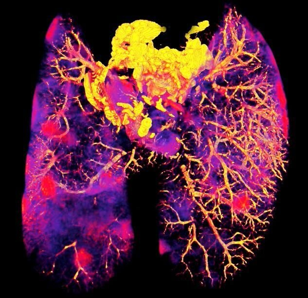 Палочка Коха (Mycobacterium tuberculosis) инфицировала лёгкие мышей. Компьютерная томография лёгких у мышей, заражённых палочкой Коха. Красные вкрапления указывают на расположение гранулём (узелков) в инфицированной ткани. Эти участки были дополнительно изучены для выявления распределения внутри клеток противотуберкулезного препарата бедаквилина и его расположения в специфических иммунных клетках. Авторство фото: Тони Фернс