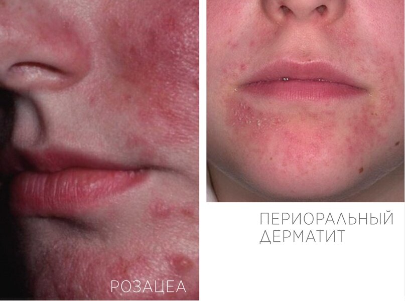 Розацеа: высыпания как на подбородке, так и центрофасциально. Периоральный дерматит: кожа вокруг рта с обязательной полоской здоровой кожи.