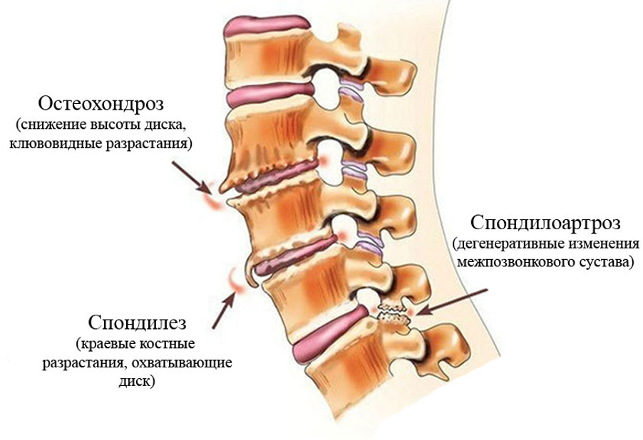 Спондилез поясничного отдела позвоночника что это. Дегенеративно-дистрофические изменения позвоночника. Остеохондроз спондилоартроз. Дистрофические дегенеративные изменения позвоночника и суставов. Спондилоартроз пояснично-крестцового отдела позвоночника корсет.