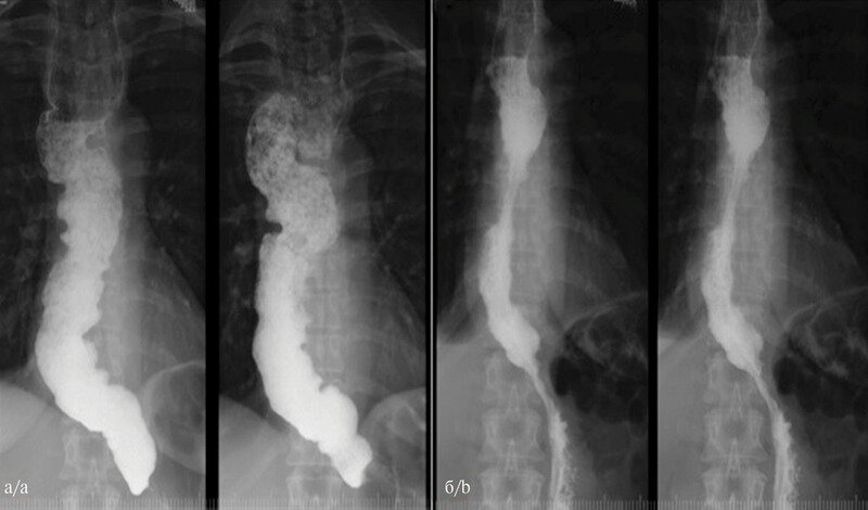 Ахалазия кардии (ахалазия пищевода, спазм пищевода)