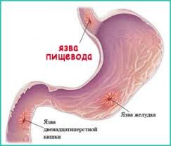 Само заболевание начинается с образования небольших эрозий, далее, при нарушении питания (отсутствия поддерживающих диет), при отсутствии лечения или запоздалой диагностике болезни, такие эрозии могут перейти в язву.