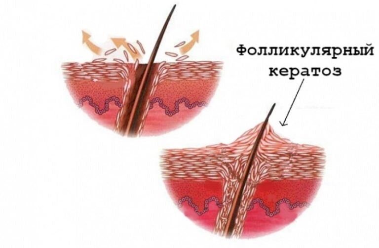 Кератоз на лице - как убрать, эффективные процедуры