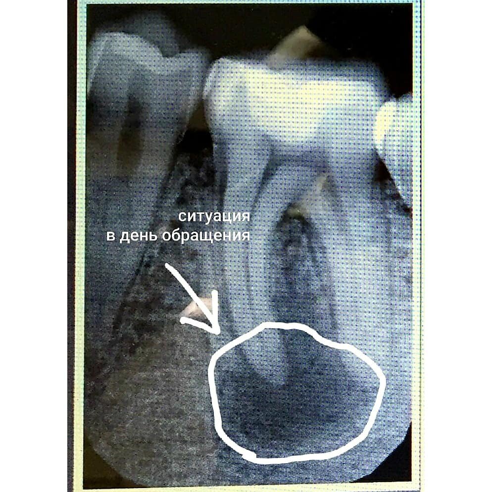 Ситуация в день обращения, на фото обведен очаг воспаления вокруг корня зуба 