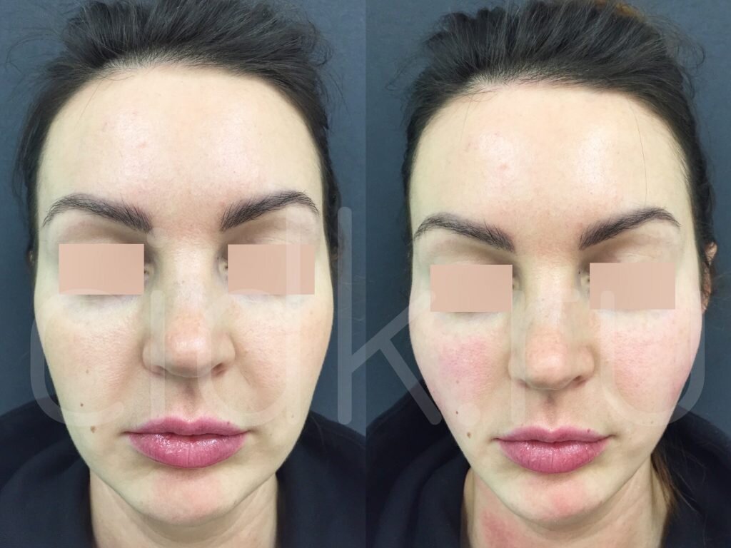 Радиесс до/после