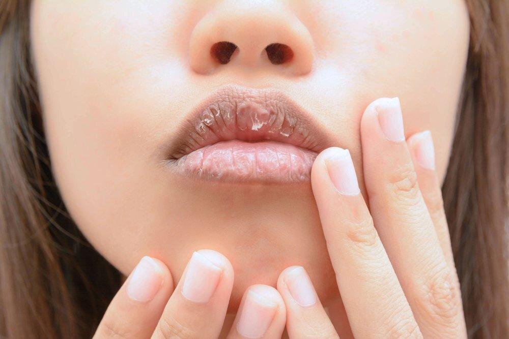 Почему трескаются губы и что с этим делать? → Полезные советы