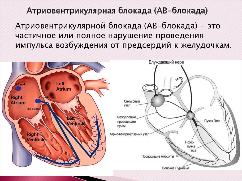 Блокада левого у сердца