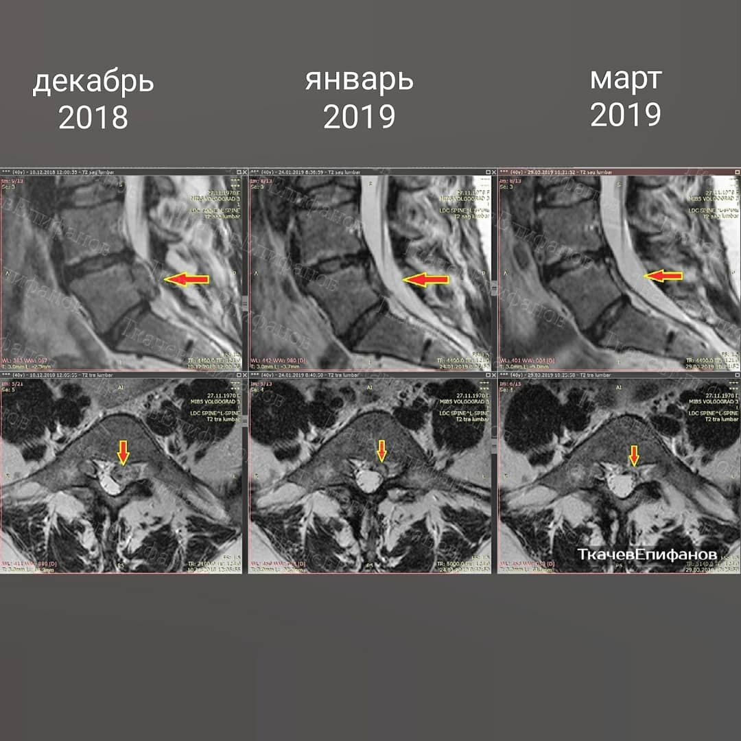 резорбция грыжи межпозвонкового. грыжа межпозвоночного диска неврология. резорбция межпозвонкового диска. резорбция секвестрированной грыжи. резорбция грыжи что это такое доктор файзулин.