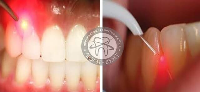 Лечение лазером воспаления десен.