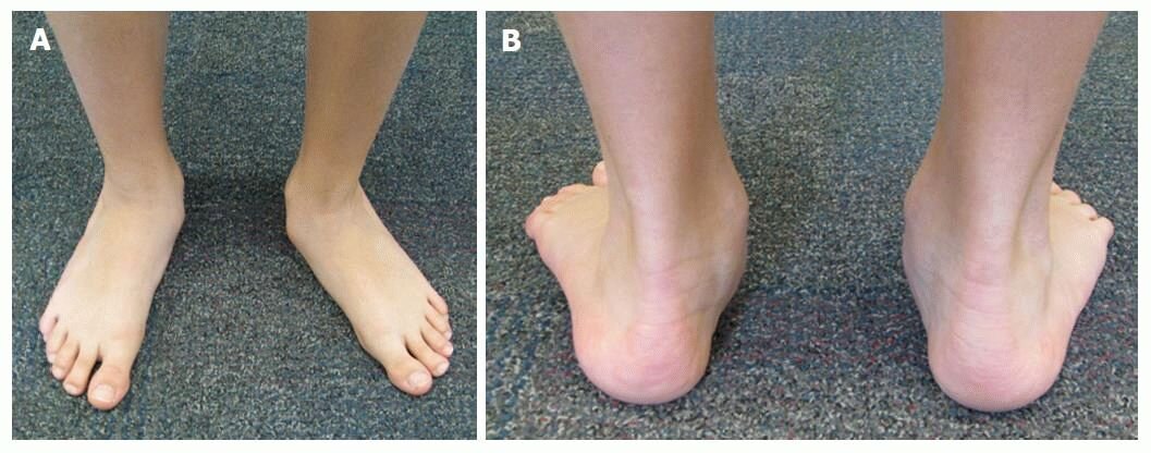 Вальгус голеностопного сустава. Вальгус деформация стоп. Косолапость и плоскостопие.