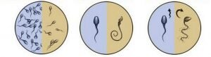 O, sperma analizini təhvil verib, nəticələr haqqında həkimlə müzakirə edəcək. Spermatozoidlərin hərəkətliliyinin pozulması, mayalanma üçün yetərli sayda olmaması və həmçini spermatozoidlərin böyük konsentrasiyası - döllənməyə təsir edir.