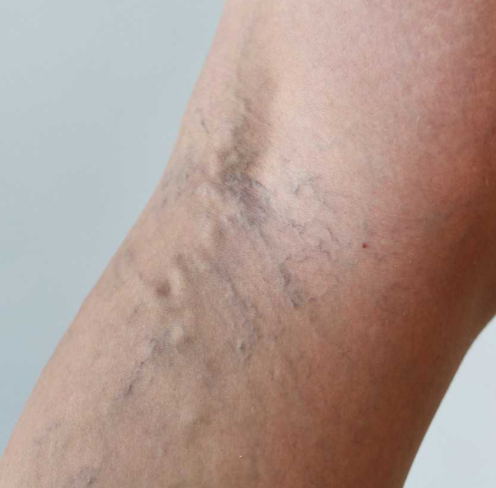 варикоз на ноге