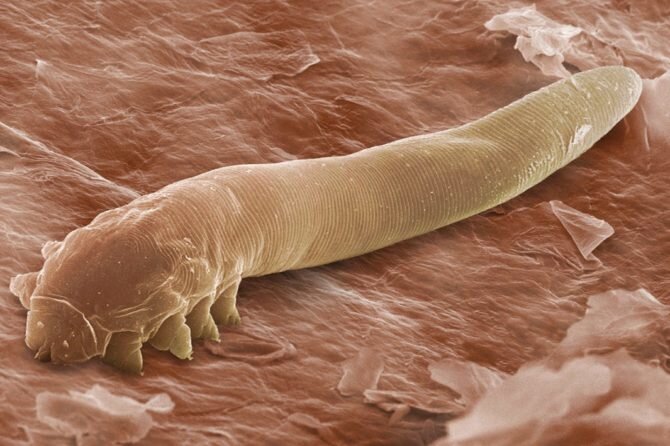 Анкилостомидоз – одно из заболеваний, причиной которой чаще всего является несоблюдение правил личной гигиены. Характеризуется заражением организма гельминтами – круглыми червями. Существует несколько видов червей, часть паразитируют только в организме человека, часть встречаются и у животных. Попасть в организм могут как с пищей (чаще всего с немытыми овощами и фруктами), так и через кожу ног. Средняя продолжительность жизни одного червя – более 5 лет! Любите гулять по пляжу или траве босиком? Будьте готовы к тому, что при очередном профосмотре у вас будет диагностирован анкилостомидоз!