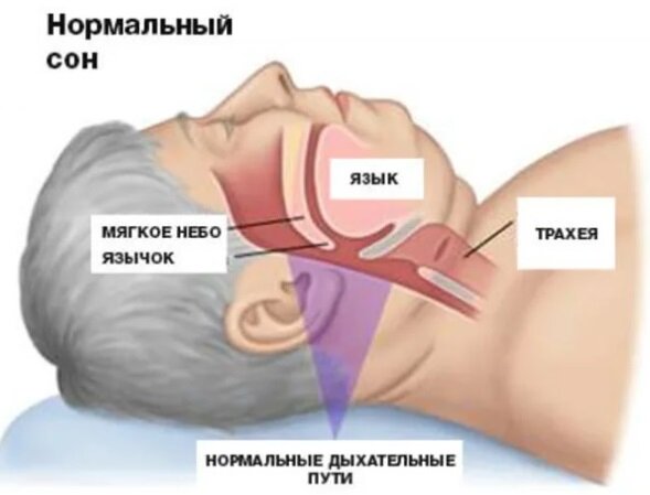 Центральное апноэ сна