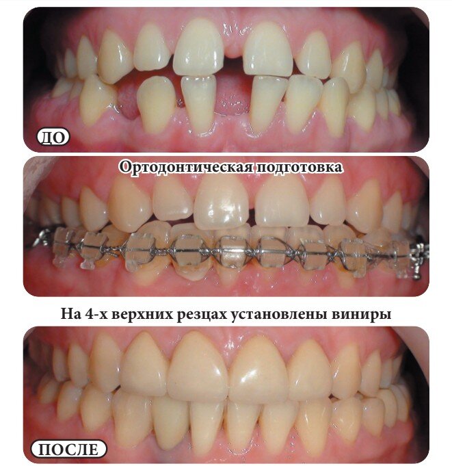 Результат сложного комплексного лечения пациентки 22 лет, которой проводилось на первом этапе исправление положения зубов, затем имплантация и протезирование. На 4-х верхних резцах были установлены фарфоровые спекаемые виниры из-за маленьких размеров зубов. Срок лечения составил 3,5 года, из них 3 года продолжалось ортодонтическое лечение.