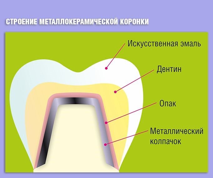 Металлокерамическая коронка картинки