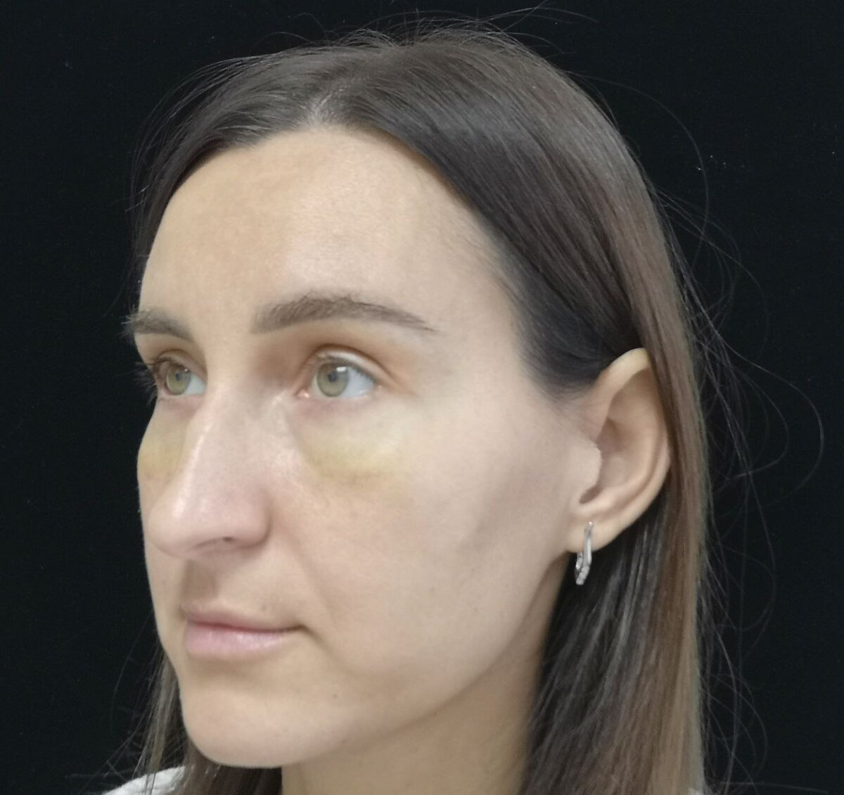 Пациентка Виктория на осмотре спустя 9 суток после трансконъюнктивальной жиросохраняющей блефаропластики с транспозицией орбитального жира в область борозд для заполнения контурной деформации нижнего века и сглаживания перехода веко/щека