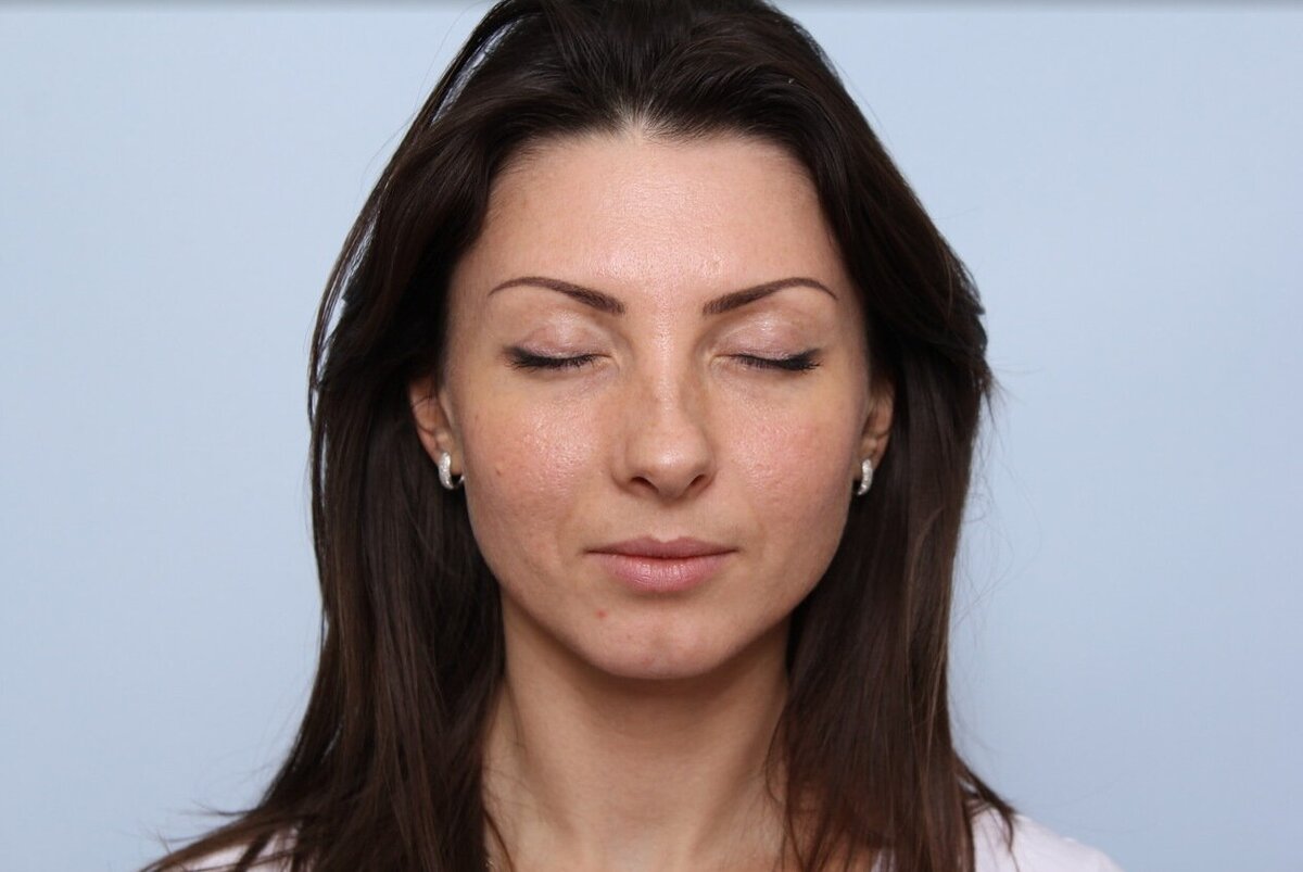 Пациентка после блефаропластики 