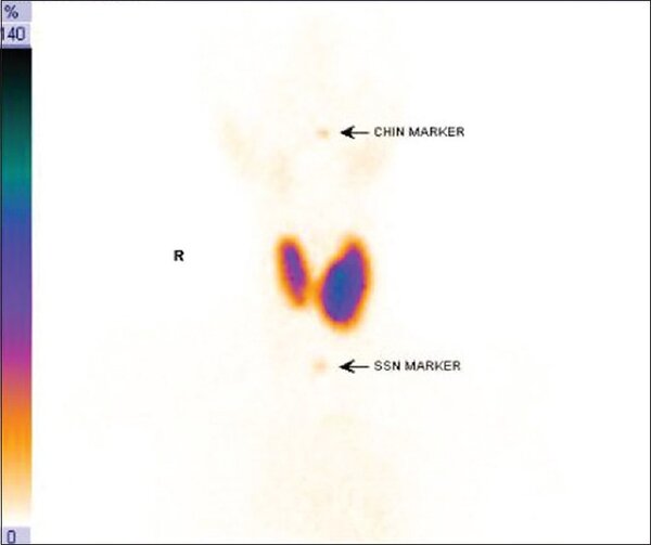 Снимок сцинтиграфии щитовидной железы из статьи. Видно асимметричное накопление препарата.