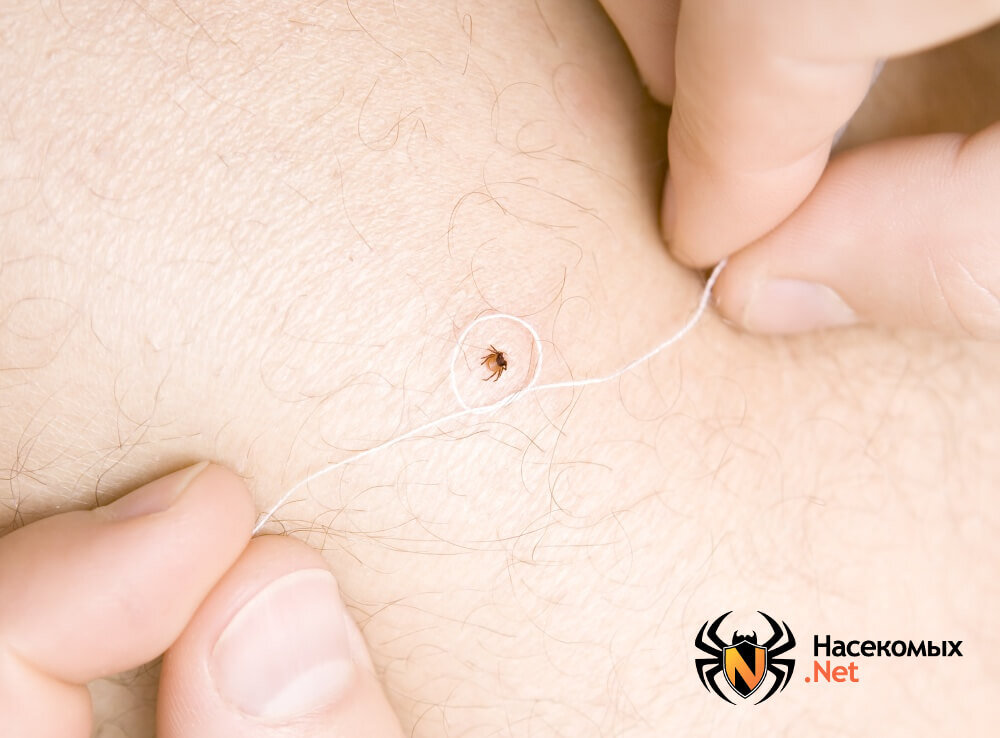 Выведение клеща