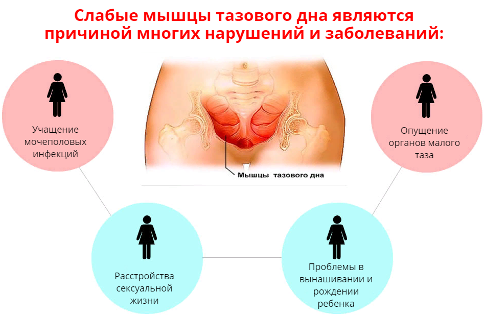 Как укрепить мышцы тазового дна?