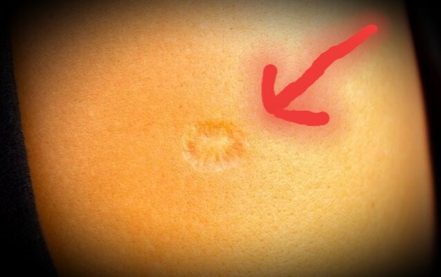 Может вовсе не прививка?