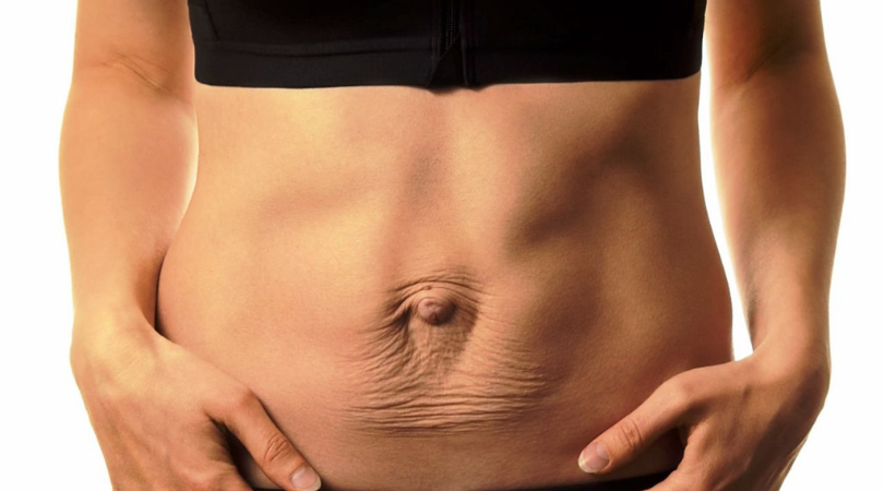 Так обычно выглядит послеродовой диастаз