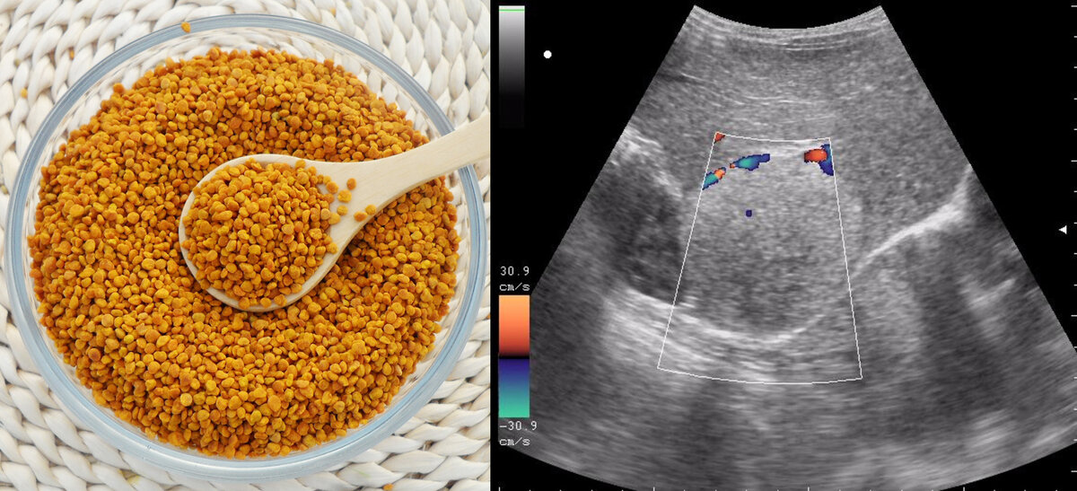 Опухоль печени и пыльца