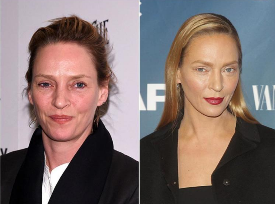 После того как Ума Турман появилась на публике с "новым лицом" , очевидцы стали отмечать, что черты ее лица потеряли живость, улыбка стала неестественной,глаза заметно сузились. Еще не совсем не повезло.