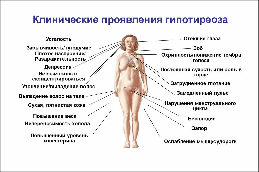 Признаки причины щитовидной железы. Клинические проявления гипотиреоза. Основные клинические проявления гипофункции щитовидной железы. Гипотиреоз щитовидной железы симптомы. Тиреотоксикоз и гипотиреоз.