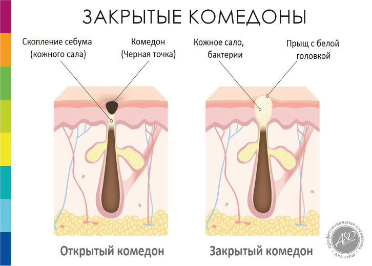 Закрытые и открытые комедоны – что это такое и как их убрать?