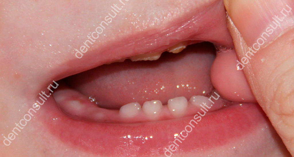 Процесс прорезывания первых зубов у ребенка. Фото: dentconsult.ru