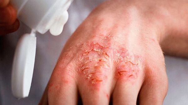 Трещины на пальцах: причины появления, как лечить, профилактика появления.