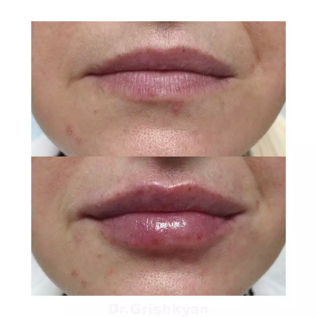 Увеличение губ гиалуроновой кислотой фото до и после. Фото с сайта Д.Р. Гришкяна. Имеются противопоказания, требуется консультация специалиста
