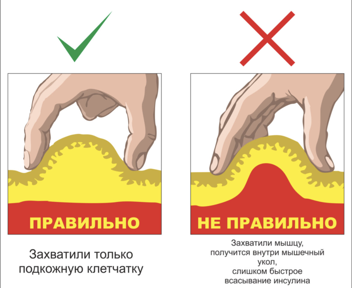 Подкожная инъекция инсулина алгоритм