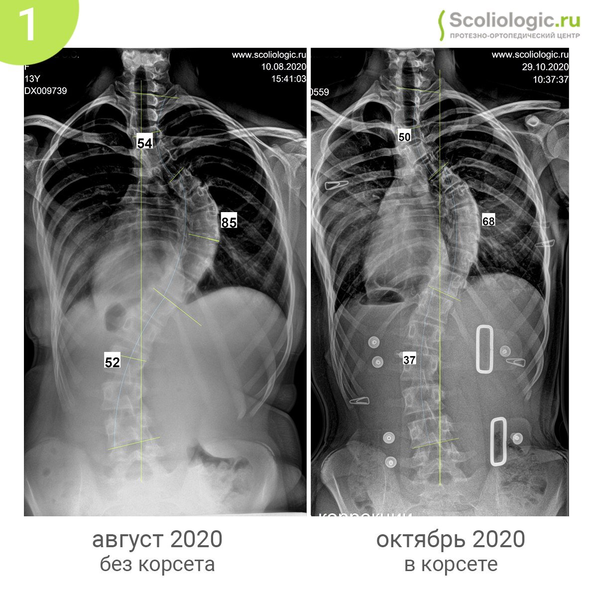 Сколиолоджик. Тест риссера рентген. Сколиотическая деформация.