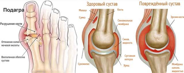 Подагра коленного сустава. Опухоль сустава большого пальца.