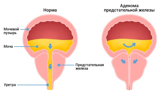 Аденома простаты приводит к сужению мочеиспускательного канала, что затрудняет мочеиспускание.