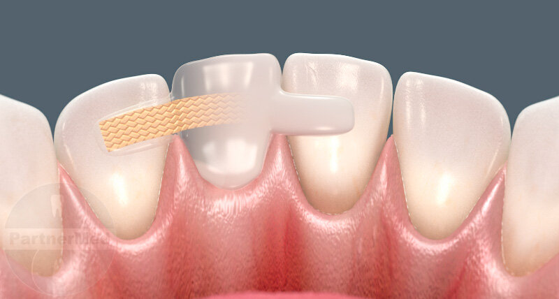 Восстановление испорченного супер клеем переднего зуба вкладкой CEREC