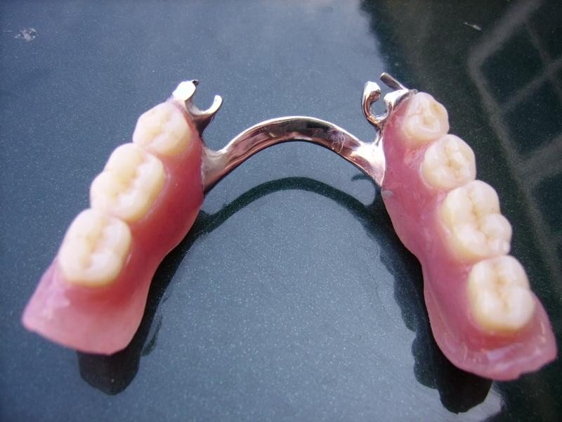 Съемный бюгельный протез