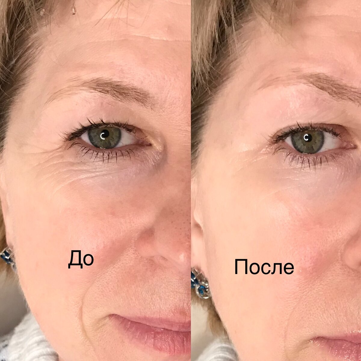 После первого применения, морщинки стали менее глубже
